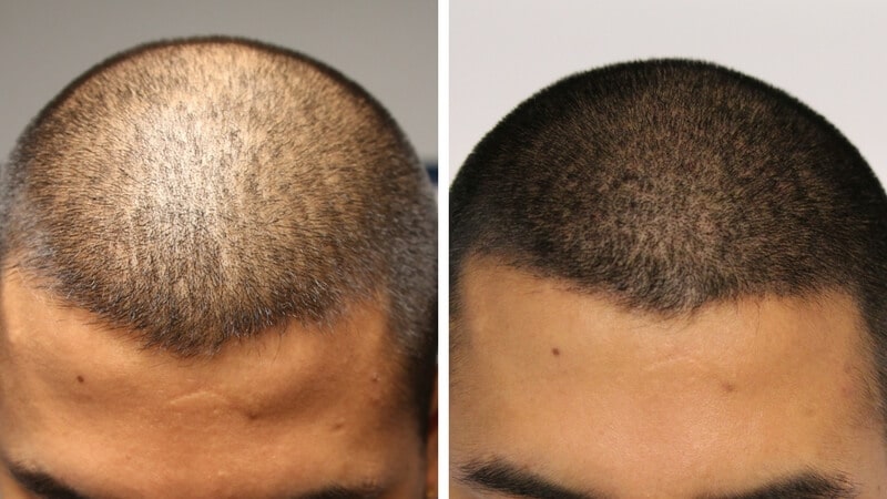 Scalp micropigmentation men