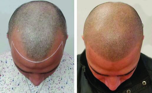 Scalp micropigmentation men